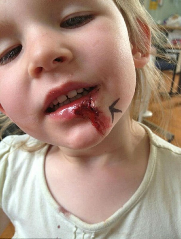 Однажды маме Оливии позвонили из детского сада и сказали, что девочка упала и ее нижний зуб проткнул