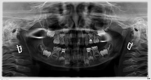 Стоматологический ликбез. Расшифровка ортопантомограммы. 