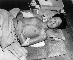 Молодой человек, ставший жертвой второй атомной бомбы, лежит на подстилке в городе Нагасаки. В результате бомбардировки сразу же погибло 70 000 человек, ещё десятки тысяч умерли впоследствии от облучения радиацией. (AP Photo)