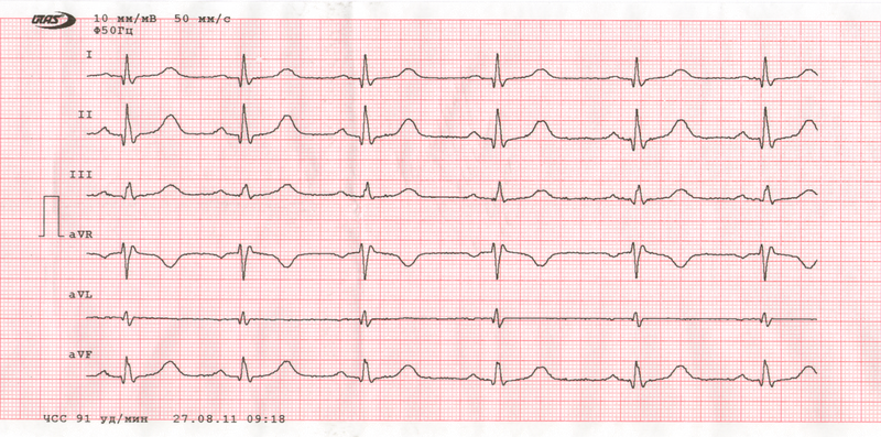 Диффузные изменения экг что это значит. Хорошая кардиограмма сердца. Метаболические изменения в миокарде на ЭКГ. Диффузные изменения миокарда левого желудочка на ЭКГ. Хорошая кардиограмма сердца здорового человека.