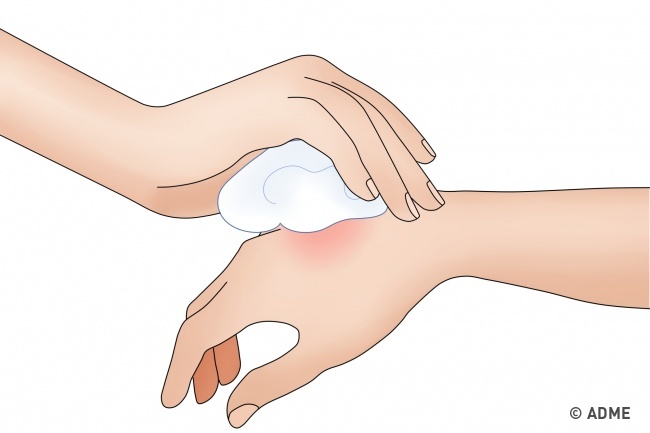 Сначала рану следует промыть мыльным раствором, а затем нанести небольшой слой противовоспалительной