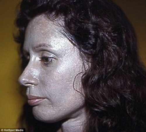 После применения капель для носа женщина покрылась серебряным панцирем